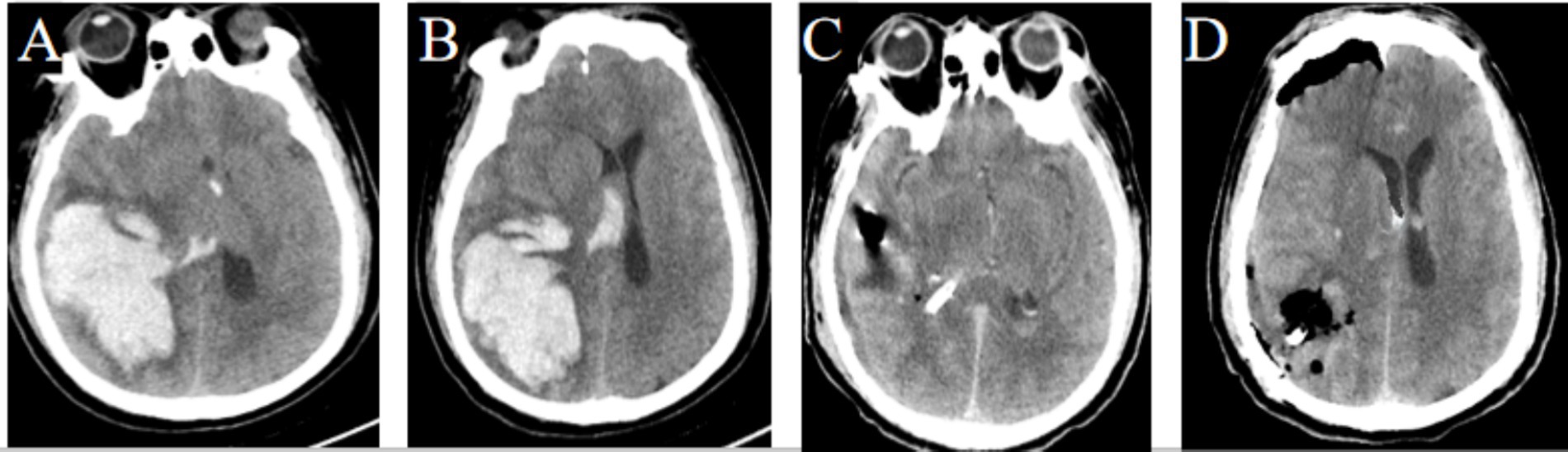 Four-panel image showing CT scans of a brain. Panel A and B depict a large hypodense area indicating ischemic stroke. Panel C shows a dark region likely representing hemorrhagic transformation. Panel D displays a similar dark region with additional hypodensity.