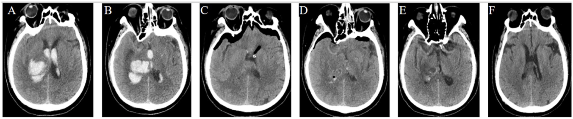 CT scan series with six axial brain images labeled A to F, showing progression over time. Initial images depict a brain hemorrhage with significant white areas indicating bleeding. Progressing scans reveal decreasing intensity and volume of the hemorrhage, eventually showing resolution and returning to normal brain structure in the final scans.
