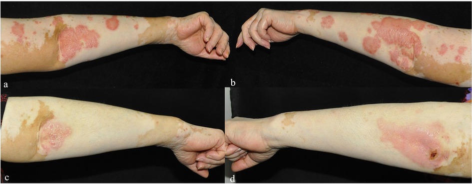 Four images labeled a, b, c, and d show a comparison of skin conditions on a person's forearm. The top two images (a, b) display red, inflamed patches with scaling. The bottom two images (c, d) show significant improvement, with reduced redness and clearer skin.
