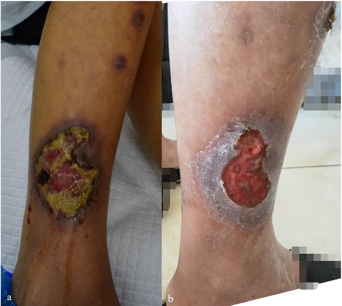 Two images depicting leg ulcers. Image a shows a leg with multiple circular ulcers, one prominent with yellow and red discoloration surrounded by darker skin. Image b displays a leg with a large ulcer featuring a red, raw appearance and surrounding dry, flaky skin.