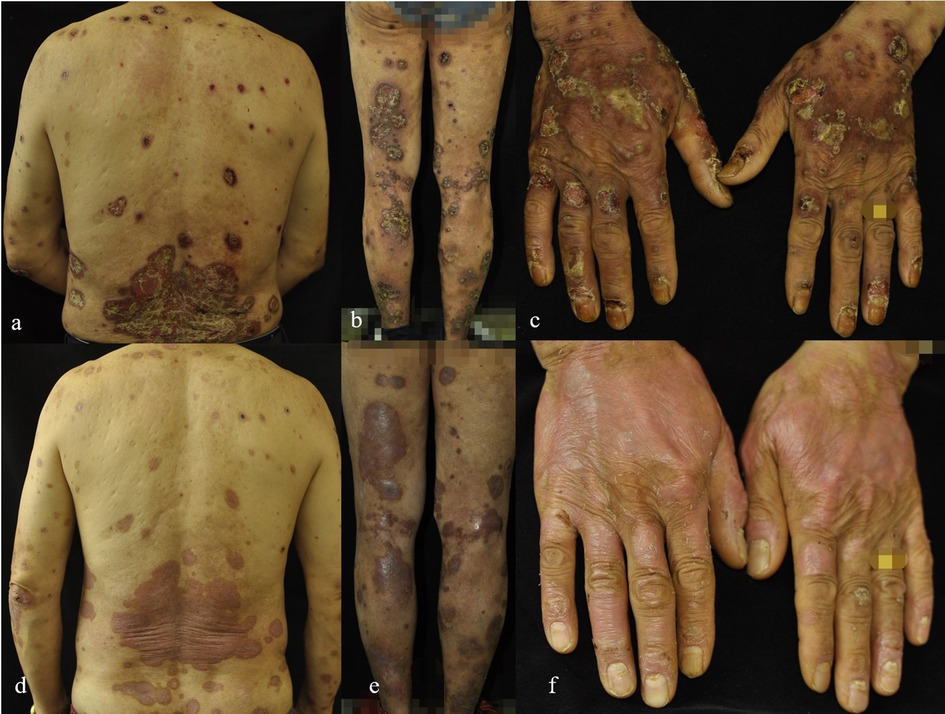 Collage of images showing skin conditions on a person's back, legs, and hands. Panels (a) and (b) depict severe lesions and scaling. Panel (c) shows heavily affected hands with crusting. Panels (d) and (e) illustrate post-treatment with reduced lesions. Panel (f) shows improved hands with less redness and scaling.