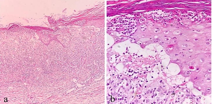 Histological images showing two panels. Panel a: Low magnification of a tissue section with dense cellular structure and layered arrangement. Panel b: Higher magnification showing detailed cellular morphology with visible nuclei and intercellular spaces. Both images feature typical hematoxylin and eosin staining with pink and purple hues.