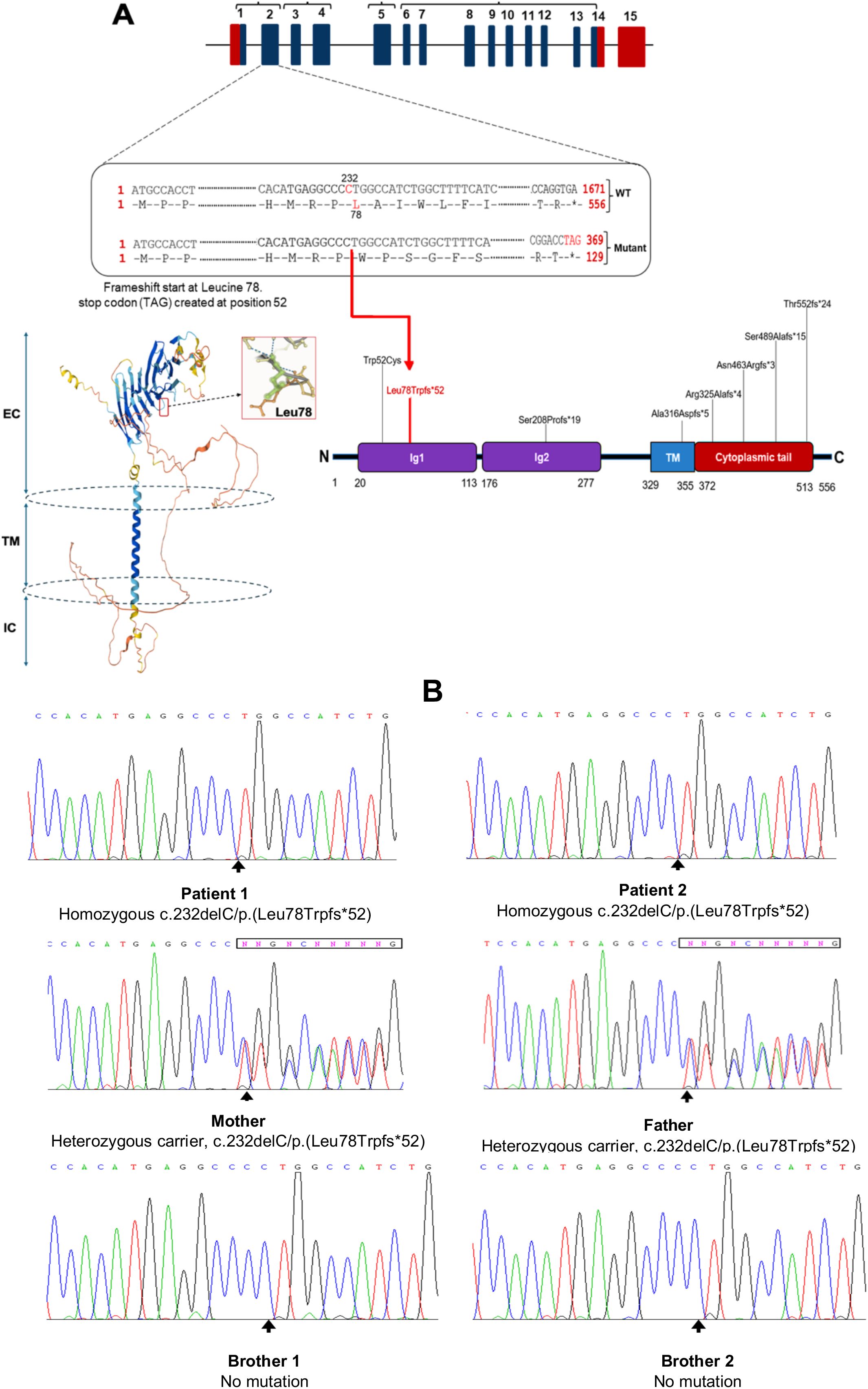 Genetic diagram showing sequence analysis. Panel A illustrates a gene structure with exons numbered one to fifteen, highlighting a mutation at Leucine seventy-eight causing a frameshift. The protein structure is annotated, showing changes like Leu78Trpfs*52. Panel B presents DNA sequencing chromatograms for multiple family members. Patients one and two are homozygous for c.232delC mutation; the mother and father are heterozygous carriers, while brothers one and two show no mutation.