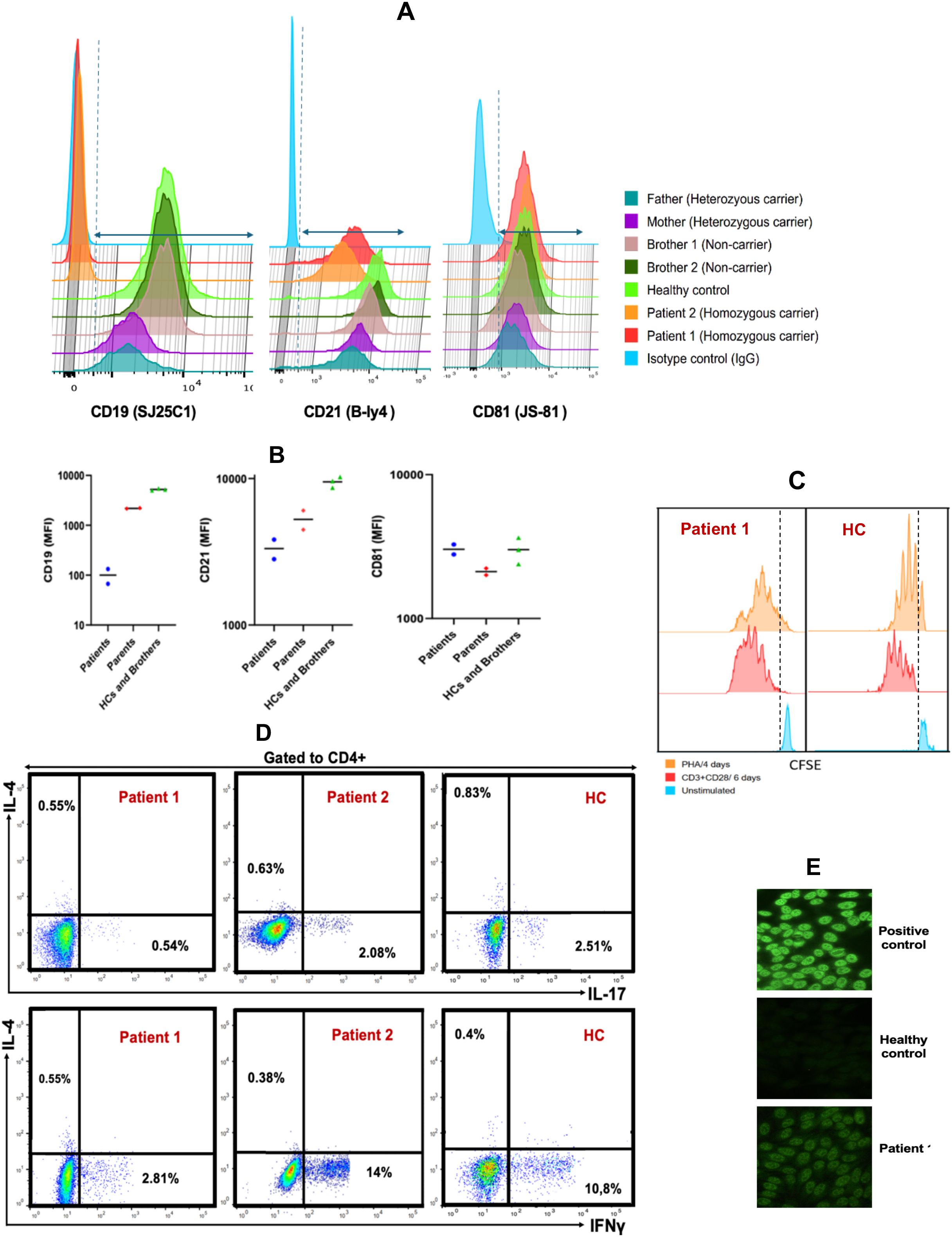 Flow cytometry analysis displaying various panels. Panel A shows histograms for CD19, CD21, and CD81 markers with different profiles based on carrier status and health controls. Panel B presents mean fluorescence intensity (MFI) data for CD19, CD21, and CD81. Panel C displays CFSE proliferation patterns comparing Patient 1 to healthy controls. Panel D shows dot plots for IL-4, IL-17, and IFNÎł expressions in CD4+ T cells for patients and controls. Panel E contains fluorescence microscopy images illustrating cellular staining, comparing positive control, healthy control, and a patient sample.