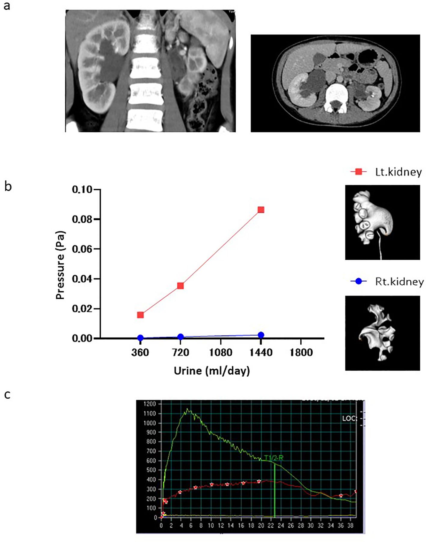 CT scans and graphs related to kidney function analysis. Image a shows coronal and axial CT scans of kidneys. Image b is a graph plotting urine output versus pressure for the left (red) and right (blue) kidneys, with 3D models of the kidneys. Image c displays a graph illustrating a function curve with marked data points and labeled T1/2R.