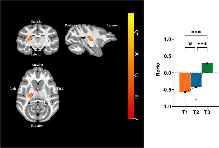 Brain MRI scans showing group differences in diffusion metrics. Panel A illustrates fractional anisotropy (FA) differences, panel B shows mean diffusivity (MD), panel C presents axial diffusivity (AD), and panel D depicts radial diffusivity (RD). Red areas indicate significant changes where T2 is less than T1, with green outlines highlighting structural features. Labeled
