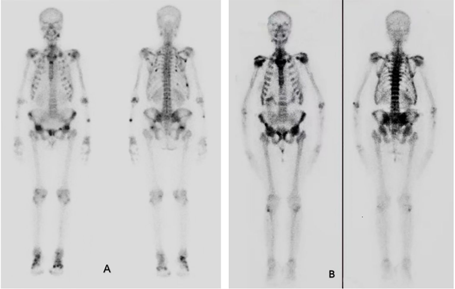 Bone scintigraphy image with two panels labeled A and B. Panel A shows two full-body views with moderate radioactive tracer uptake. Panel B shows two full-body views with higher tracer uptake concentrated in the axial skeleton and joints.