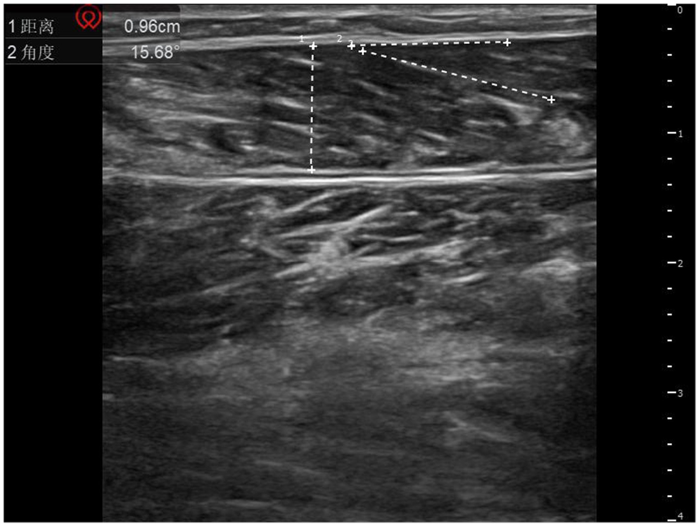 Ultrasound image showing soft tissue with measurements marked by two dashed lines, indicating a length of 0.96 centimeters and an angle of 15.68 degrees. The background is grayscale with irregular textures, typical of ultrasound imagery.