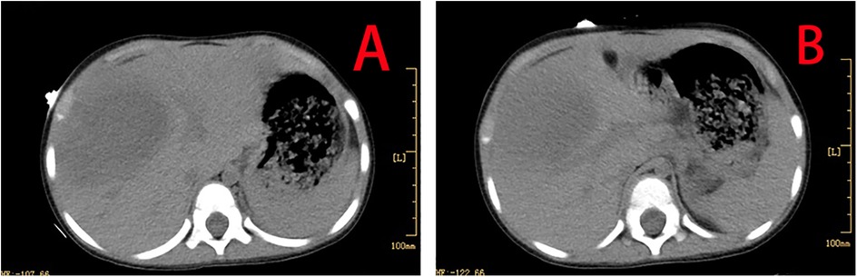 CT scan images in panels labeled A and B showing liver sections. Panel A indicates a region with a dark mass, suggesting an abnormality. Panel B shows a more distinct mass. Both images include anatomical markers.