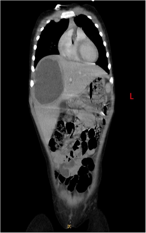 CT scan image showing a coronal cross-section of a human torso. Visible are the lungs, heart, liver, and intestines, along with the spine on the right. The letter \