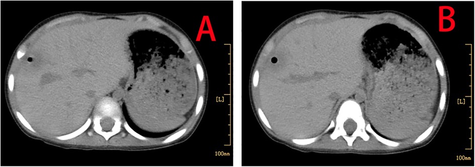 CT scan images labeled A and B show cross-sections of the abdomen with noticeable differences. Image A highlights a darker area, likely representing a fluid or air pocket in the stomach, while image B shows a similar structure but with fainter contrast. Both images include a scale for reference.