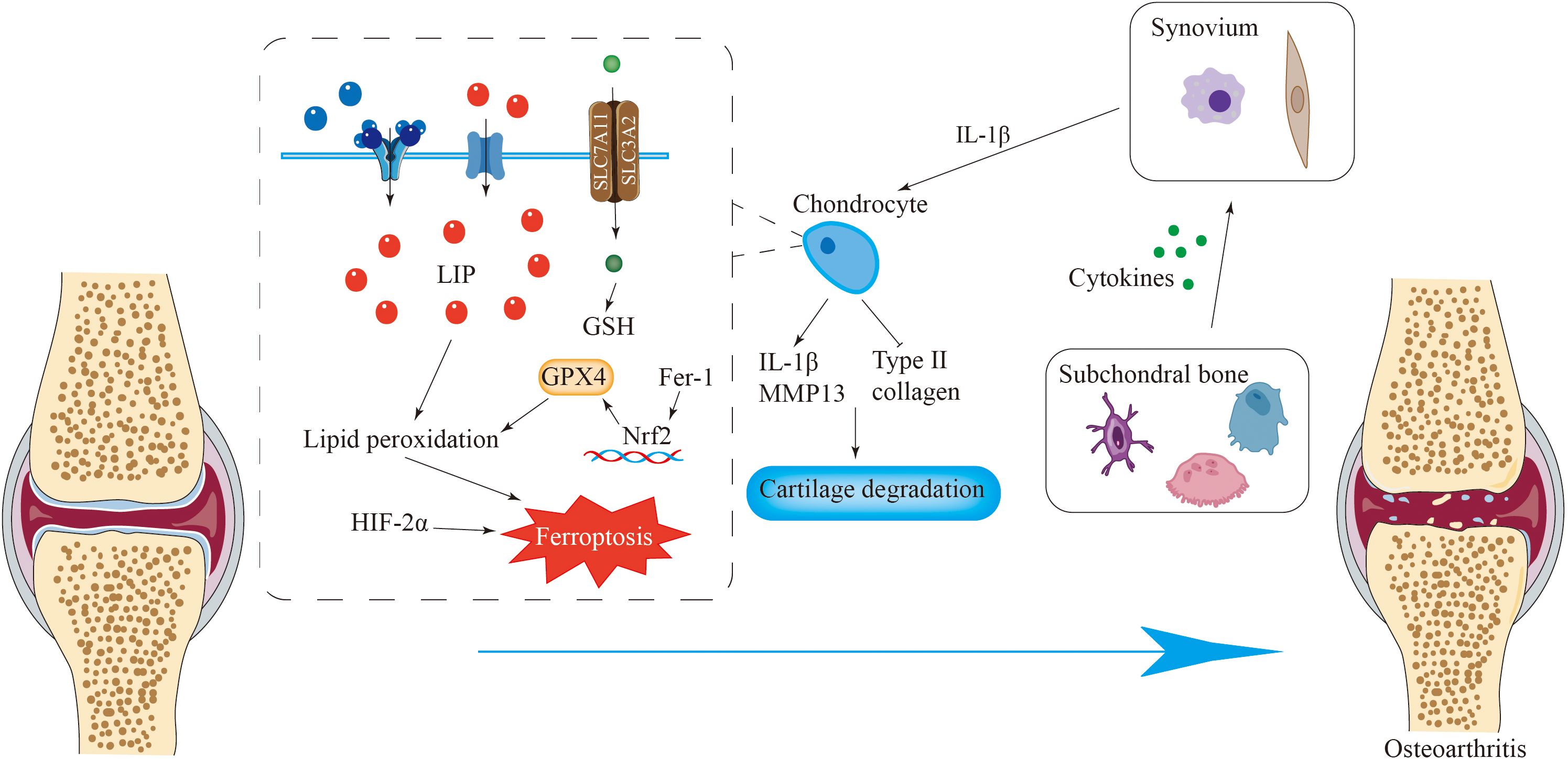 Diagram illustrating the biochemical pathway involved in osteoarthritis development. It shows lipid peroxidation and ferroptosis leading to chondrocyte degradation and cartilage breakdown. Elements include LIP, GSH, GPX4, HIF-2α, IL-1β, and cytokines, impacting synovium and subchondral bone.