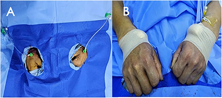 The left panel shows the patient's hands protruding through blue surgical drapes during the procedure, with arterial sheaths inserted in both distal radial arteries. The right panel shows the puncture sites of both distal radial arteries bandaged with white gauze and bandages.