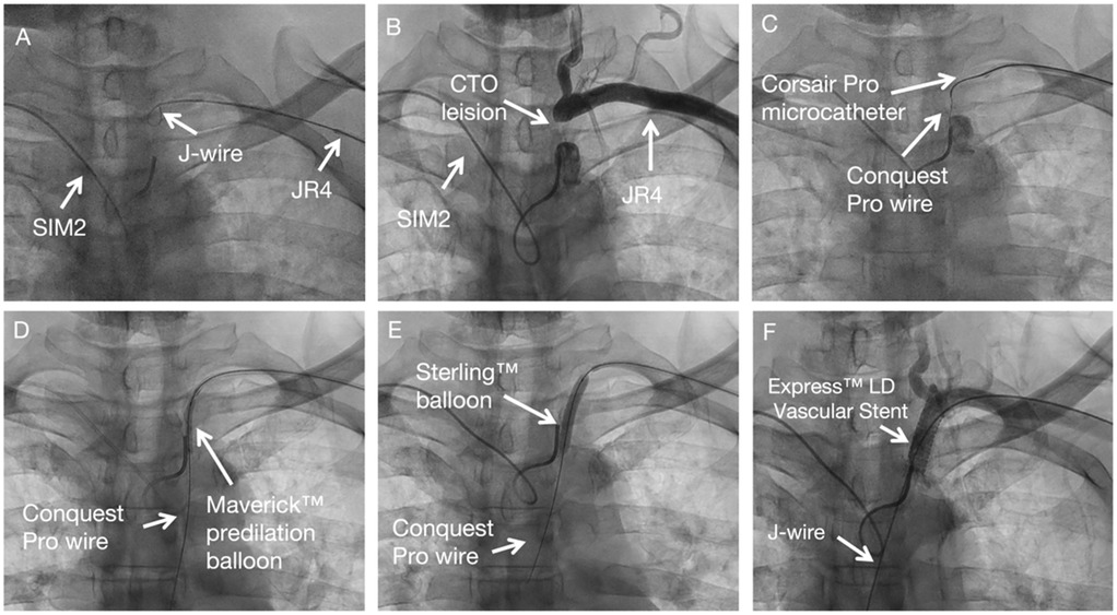 A series of six sequential digital subtraction angiography (DSA) images demonstrating the procedural steps of percutaneous coronary intervention (PCI): Panel A, a SIM2 guiding catheter and a J-tip wire in position; Panel B, the guidewire traversing the chronic total occlusion (CTO) lesion; Panel C, the Corsair Pro microcatheter advancing through the lesion with support from the Conquest Pro wire; Panel D, predilation with a Maverick balloon; Panel E, further dilation with a Sterling balloon; Panel F, delivery and positioning of an Express LD vascular stent over the guidewire.