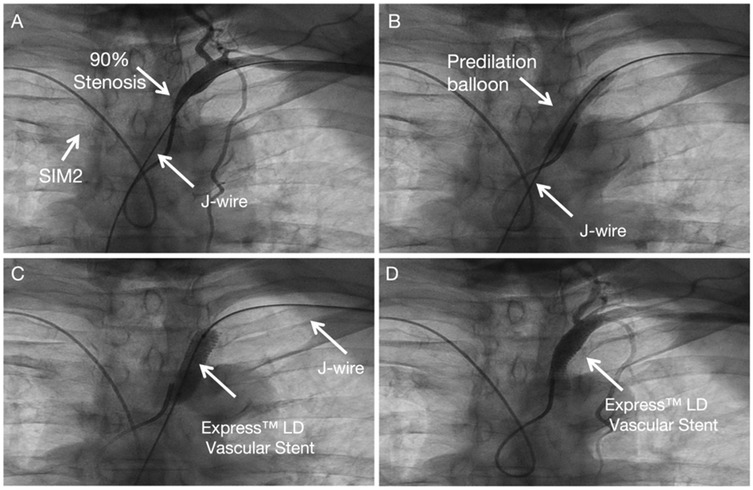 A sequence of four angiographic images. Panel A: Severe stenosis is visible at the origin of the coronary artery, with a SIM2 guiding catheter and a J-tip wire positioned at the ostium. Panel B: A balloon catheter is advanced over the wire to the stenotic segment for predilation. Panel C: An Express LD vascular stent is delivered and positioned over the guidewire at the lesion site. Panel D: After balloon inflation and stent deployment, angiography demonstrates successful resolution of the vascular stenosis with restored blood flow.