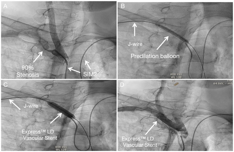 Four angiographic images from a different angle, highlighting the stent implantation outcome. Panel A: The SIM2 catheter is positioned at the coronary ostium, with severe distal stenosis visible. Panel B: The J-tip wire crosses the lesion, and a predilation balloon is prepared for expansion. Panel C: The Express LD stent is precisely delivered to the target lesion location. Panel D: Final angiographic results after successful stent deployment and expansion show significant improvement in lumen diameter and successful restoration of blood flow.
