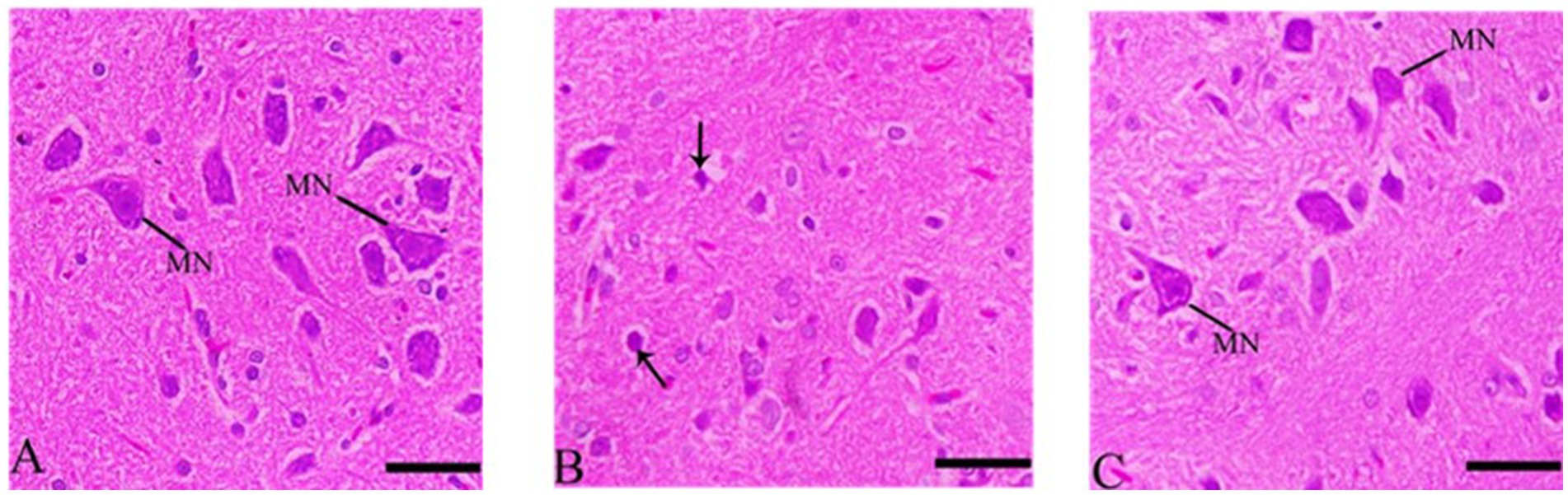Three microscopic images of brain tissue. Image A shows two multi-nucleated cells labeled MN. Image B displays areas indicated by arrows. Image C illustrates another section with MN-labeled cells. Each section shows variations in cell characteristics.