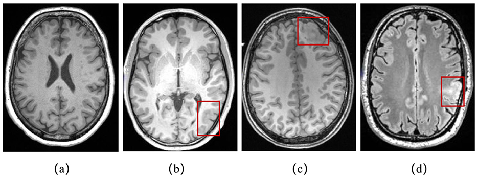 MRI scans of the brain in four frames labeled (a) to (d). Frame (a) shows a clear image of the brain structures. Frame (b) has a red rectangle highlighting an area near the temporal lobe. Frame (c) features a red rectangle over a region near the frontal cortex. Frame (d) displays a red rectangle around a region in the parietal area. Frame (b), (c), and (d) show the lesion characteristics of focal cortical dysplasia on images.