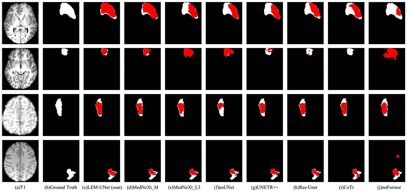 MRI brain scans are shown across four rows, each demonstrating results from different models. The columns display: (a) T1 image, (b) Ground Truth, (c) LEM-UNet, (d) MedNeXt_M, (e) MedNeXt_L3, (f) nnUNet, (g) UNETR++, (h) Res-UNet, (i) CoTr, and (j) nnFormer. Highlighted areas in red indicate areas of interest or abnormalities for comparison across models.