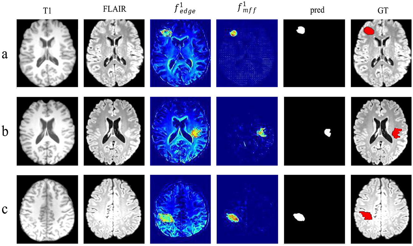 Brain MRI images are displayed in three rows labeled a, b, and c, with columns for T1, FLAIR, fedge, f1mff, pred, and GT. The images show different characteristics of brain tissue, with areas highlighted for analysis. The fedge and f1mff columns use color mapping to show intensity variations. The pred column shows predicted regions in white, while GT marks ground truth areas in red.