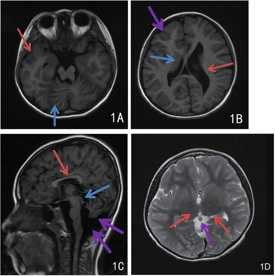 MRI brain images in axial and sagittal views labeled 1A through 1D, each marked with colored arrows indicating specific anatomical regions or abnormalities. Red arrows point to cortical and white matter structures, blue arrows highlight the cerebellum and brainstem, and purple arrows indicate periventricular and posterior fossa regions, suggesting areas of interest for neuroanatomical or pathological assessment.