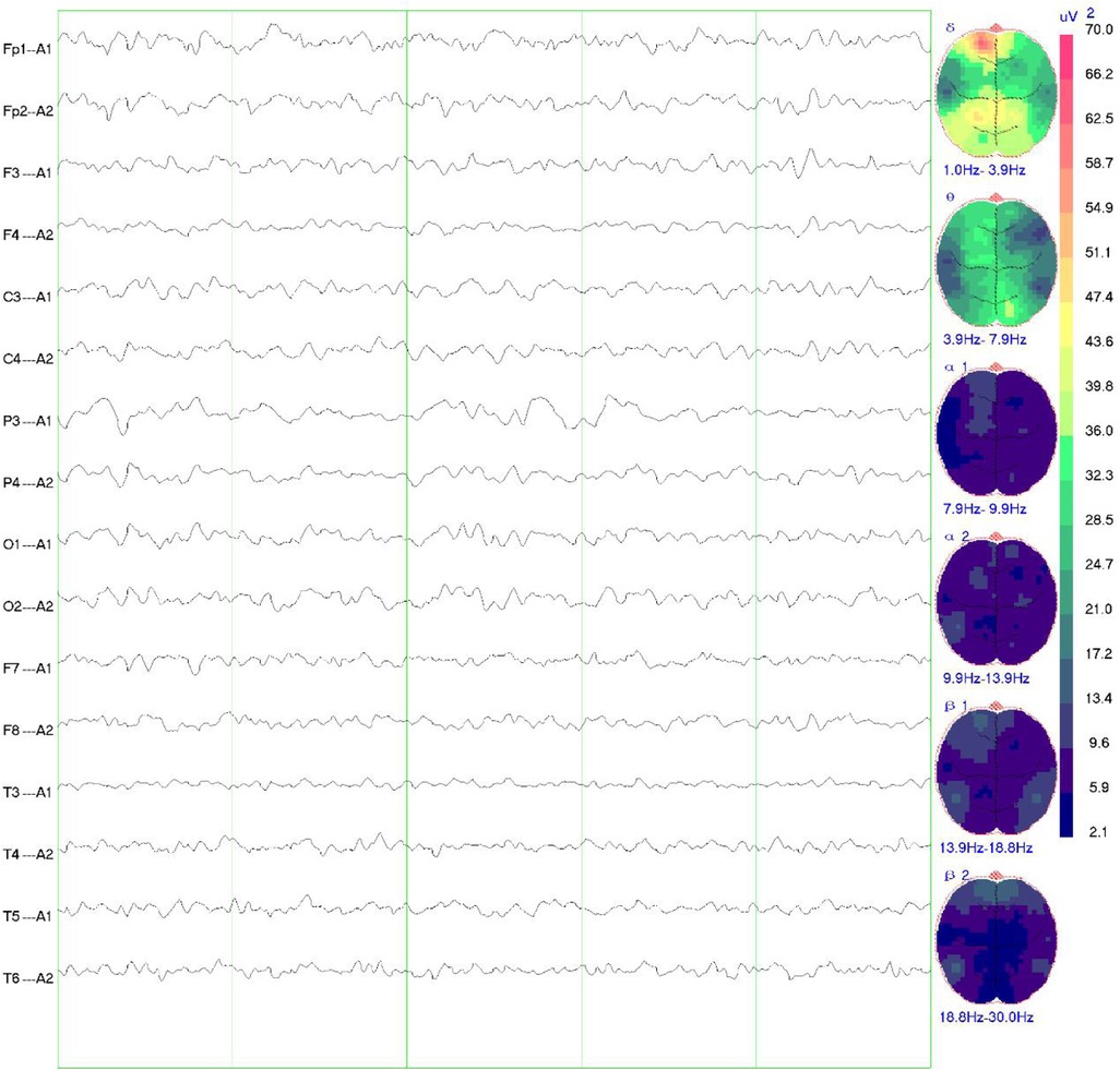 Electroencephalogram (EEG) recording showing multiple electrode channels with rhythmic brainwave activity, alongside spectral topographic maps representing power distribution across frequency bands (delta to beta-2). Topographic maps illustrate regional differences in brainwave activity, with warmer colors indicating higher power, particularly in lower frequency bands such as delta (1.0-3.9 Hz) and theta (3.9-7.9 Hz), predominantly in frontal and central regions.