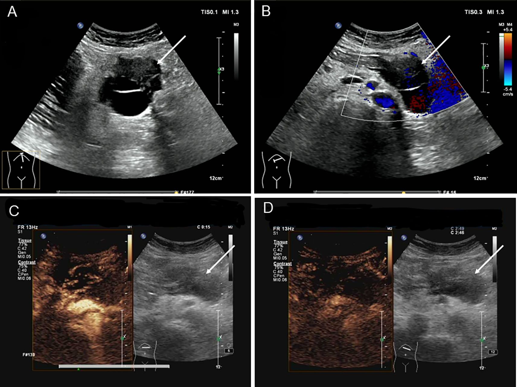 Four preoperative ultrasound panels (A–D). (A) Grayscale scan shows a cystic–solid mass between the pancreatic body and posterior gastric wall with multiple internal septa (arrow). (B) Color Doppler demonstrates minimal intralesional flow. (C) Contrast-enhanced ultrasound, early phase: peripheral heterogeneous hyperenhancementwith absent internal enhancement. (D) Late phase: uneven low peripheral enhancement with well-defined lesion margins. These images together depict a mixed echogenic lesion with limited vascularity and characteristic contrast behavior.