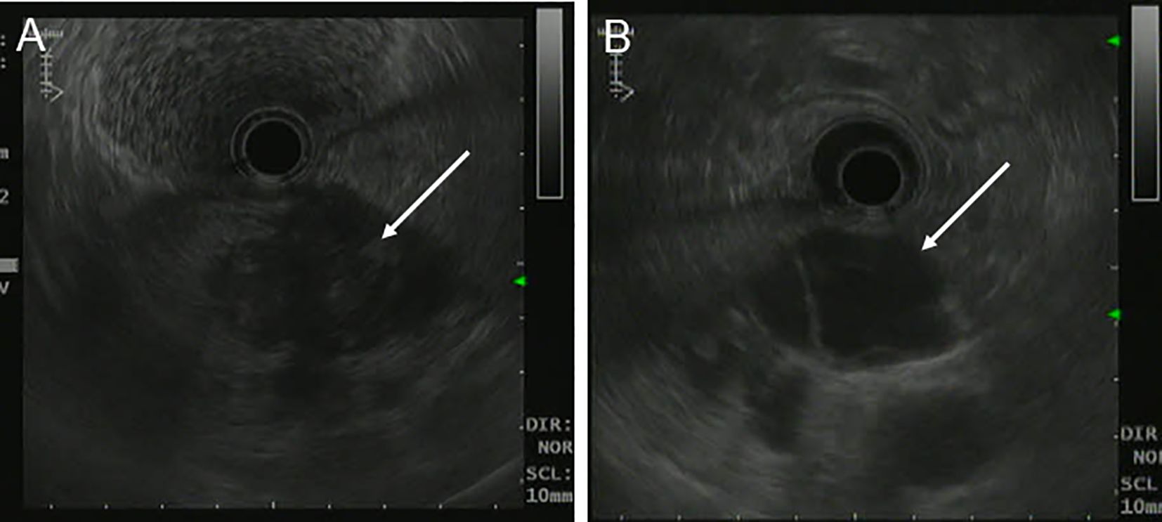 Endoscopic ultrasonography, panels A and B. A large cystic–solid mass isseen at the junction of the posterior gastric antrum and the pancreatic neck. Borders are poorly defined and cystic components predominate. White arrows indicate the lesion and internal septations. The paired views emphasize the location at the pancreatogastric interface and the heterogeneous internal architecture.