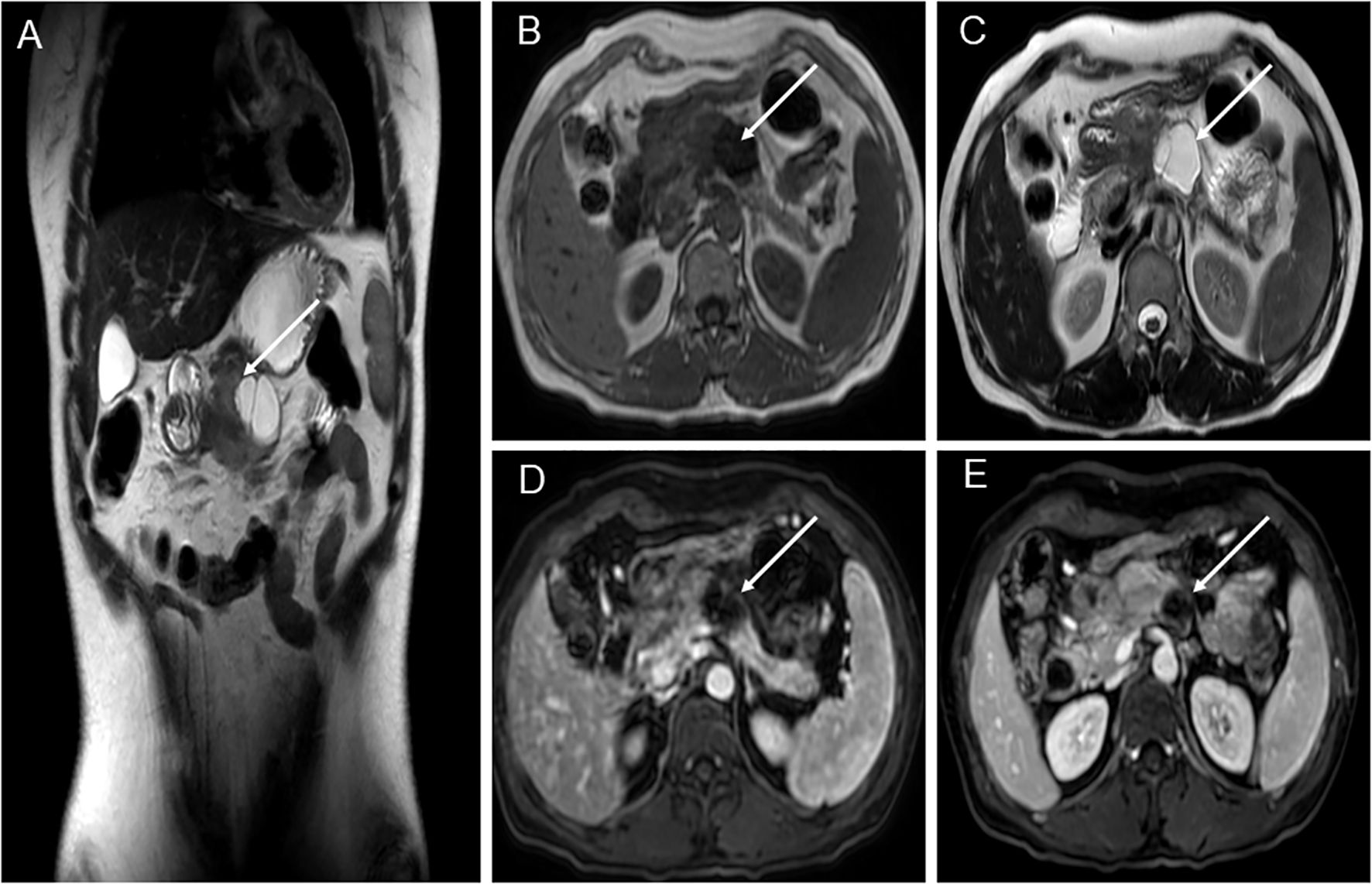 Preoperative MRI illustrating a pancreatogastric space lesion. (A) Overview shows a solid–cystic mass measuring ~3.6 × 3.6 × 2.8 cm with internal septa and indistinct borders with the gastric antrum and pancreas. (B) T1: solid portions are slightly low signal; cystic areas are low signal. (C) T2: solid portions mildly high signal; cystic areas high signal. (D) T1- weighted reference image. (E) Postcontrast imaging shows mild–moderate enhancement. Arrows mark regions of interest across sequences.