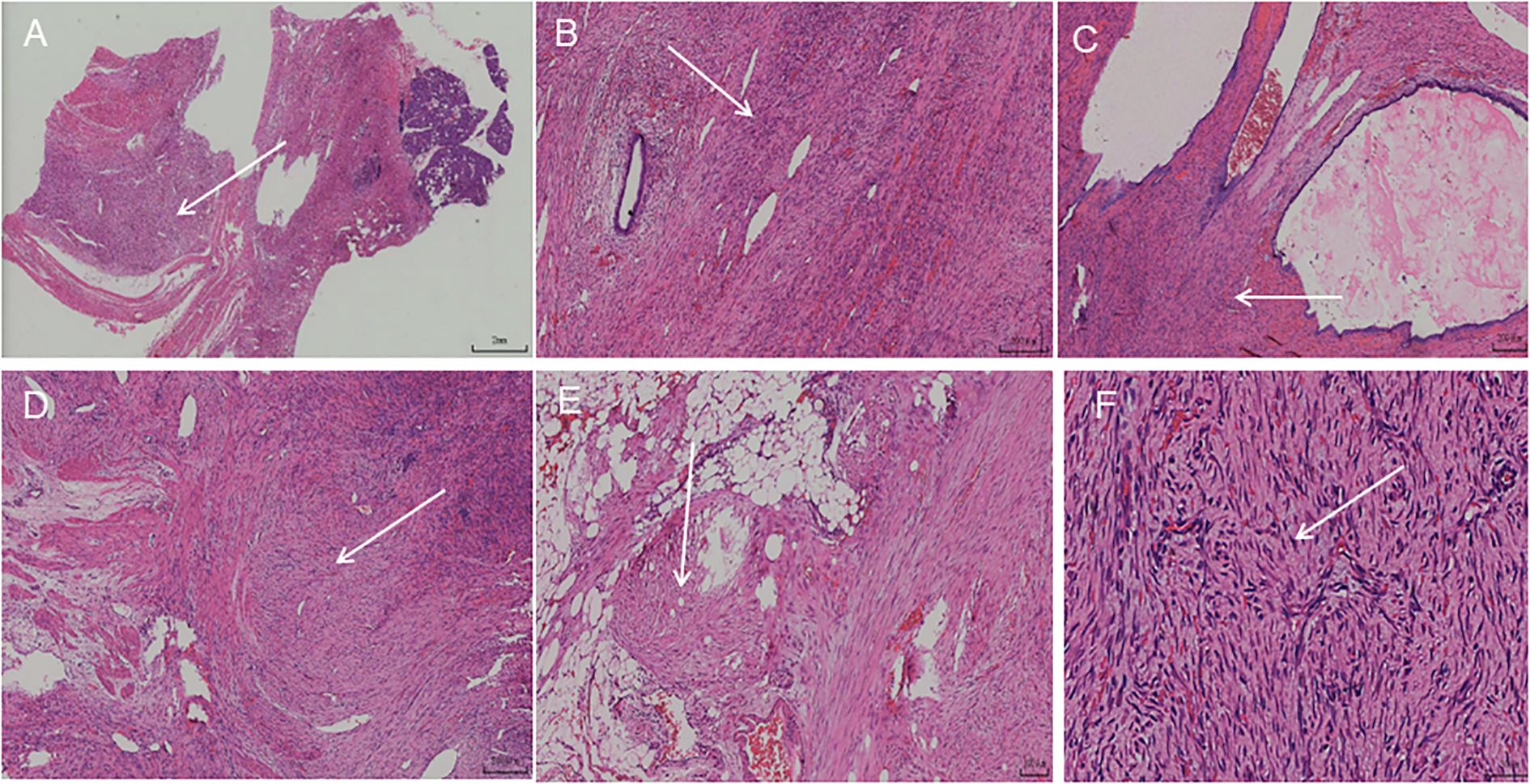 H&E-stained histology, panels A–F. (A) Low-power view shows a diffuse, patchy lesion with indistinct borders from adjacent pancreas. (B) Residual pancreatic ductal structures within the lesion. (C) Dilated, cystic ducts containing pale secretions. (D) Infiltrative growth into the pancreatic muscularis propria with interlacing spindle-cell bundles. (E) Extension into surrounding fibrofatty tissue. (F) High-power view highlights fibroblasts and myofibroblasts. Scale bars as indicated in each panel.