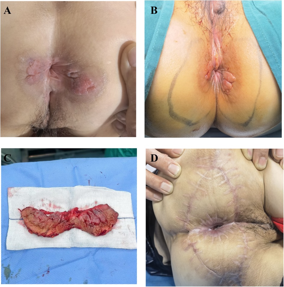 A series of four medical images depicting different stages of pilonidal sinus management. Image A shows an irritated area near the sacrum. Image B displays the area marked for surgical intervention. Image C shows excised tissue placed on a surgical cloth. Image D presents the post-operative healing with sutures.