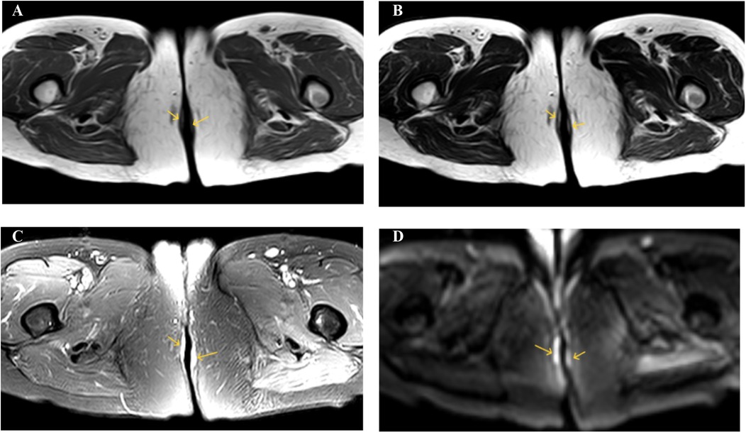 Four MRI slides labeled A through D display cross-sectional views of the pelvis. Each image shows tissue structures in black and white with yellow arrows indicating specific points of interest in the central area between the pelvic bones. The images appear to highlight differences in tissue density and structure.