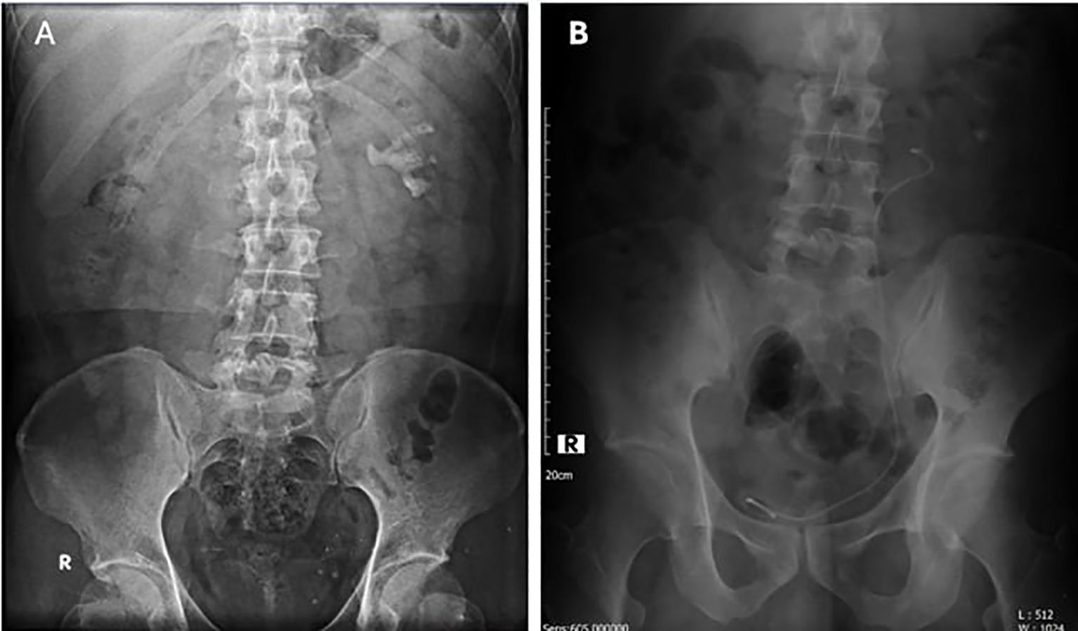 Preoperative radiographic imaging demonstrates a large staghorn calculus occupying the left renal collecting system. Following retrograde intrarenal surgery (RIRS) performed with the Direct In-Scope Suction (DISS) system, the postoperative X-ray reveals the placement of a double-J (DJ) ureteral stent and the presence of a small residual stone fragment measuring approximately 10 × 7 mm within the left kidney.