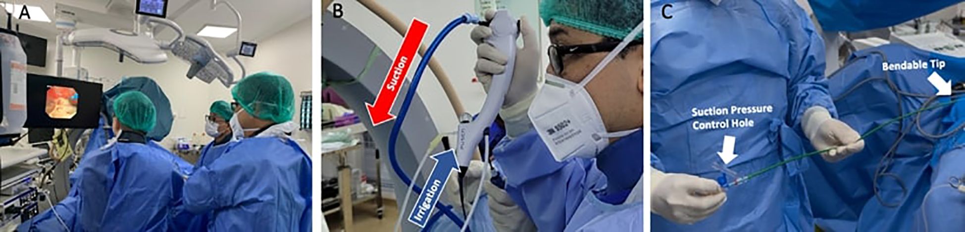 Intraoperative photographs obtained during retrograde intrarenal surgery (RIRS) illustrate the surgical setup and specialized equipment used in the procedure, including the Direct In-Scope Suction (DISS) device designed for efficient fragment evacuation, and the Flexible and Navigable Ureteral Access Sheath (FANS) that facilitates controlled access and maneuverability within the upper urinary tract.