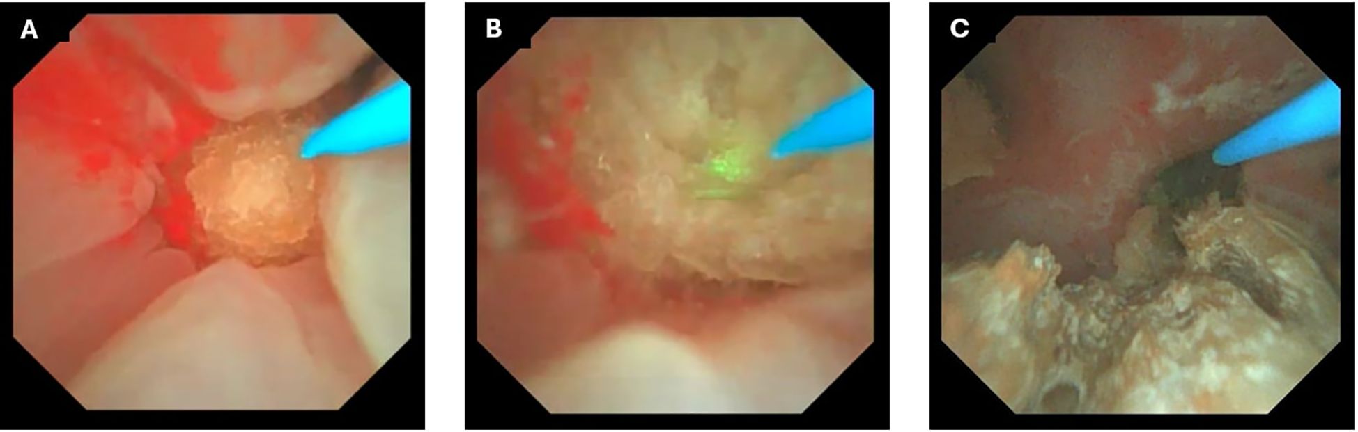 Endoscopic intraoperative views captured during retrograde intrarenal surgery (RIRS) demonstrate the use of a thulium fiber laser in combination with the Direct In-Scope Suction (DISS) and Flexible and Navigable Ureteral Access Sheath (FANS) systems. The sequence shows the visualization of a large staghorn stone prior to laser application, active laser dusting with visible ablation of the stone surface, and the subsequent appearance of fragmented stone debris within the renal calyx following partial disintegration.