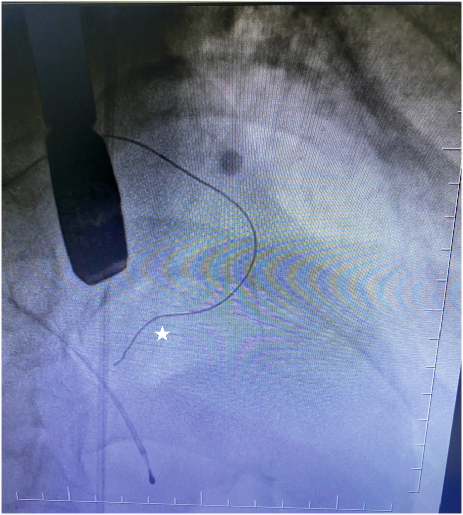 An X-ray image showing a medical device, possibly a catheter or probe, inserted and visible inside a body cavity. A white star highlights a specific point of interest on the image.