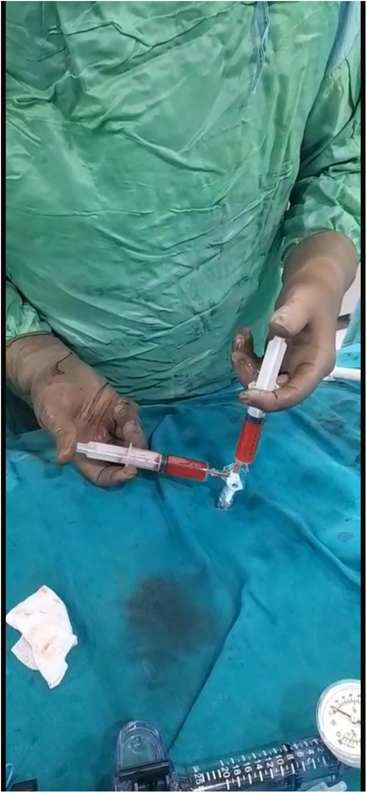 A person wearing a green surgical gown and gloves holds two syringes connected by a three-way stopcock. Both syringes appear to contain blood. A medical setup, including a pressure gauge, is visible on a blue drape.