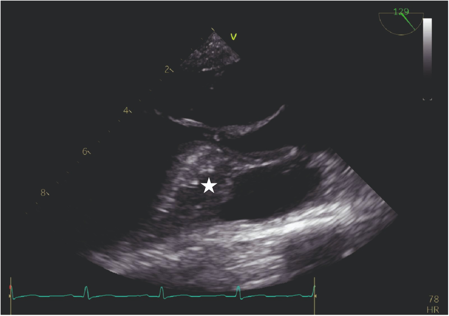 Ultrasound image showing a transverse section with several grayscale regions and a white star indicating a specific area of interest. Numeric labels and grid lines are visible along the left and top edges. An electrocardiogram (ECG) trace is displayed at the bottom, indicating a heartbeat rate of seventy-eight beats per minute.