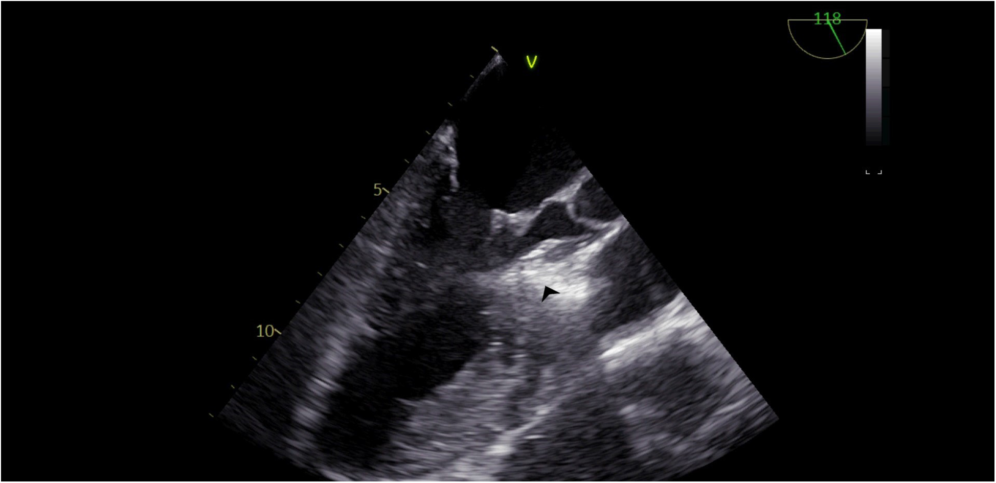 Ultrasound image showing a detailed view of internal body structures in grayscale. Features include a central dark area surrounded by lighter, textured regions. Indicators and numbers are displayed on the sides.