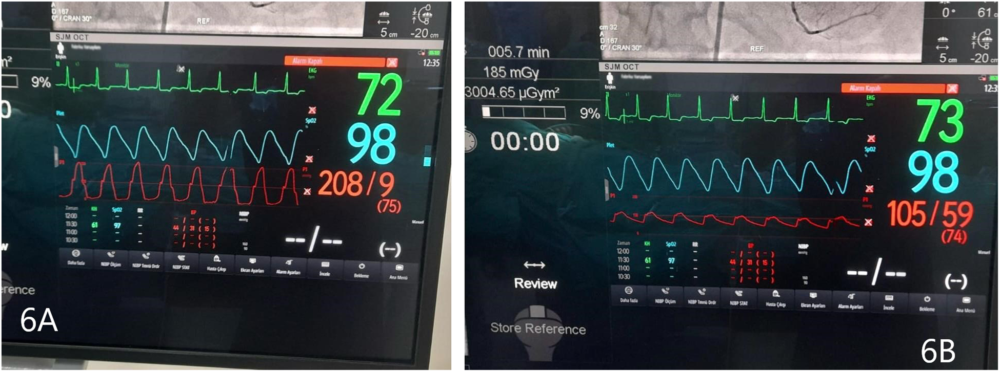 Medical monitor screens show vital signs. The left screen displays heart rate of seventy-two, SpO2 of ninety-eight percent, and blood pressure of two hundred eight over nine millimeters mercury. The right screen shows heart rate of seventy-two, SpO2 of ninety-eight percent, and blood pressure of one hundred fifty-two over fourteen millimeters mercury. Both screens feature ECG, plethysmography, and blood pressure waveforms.
