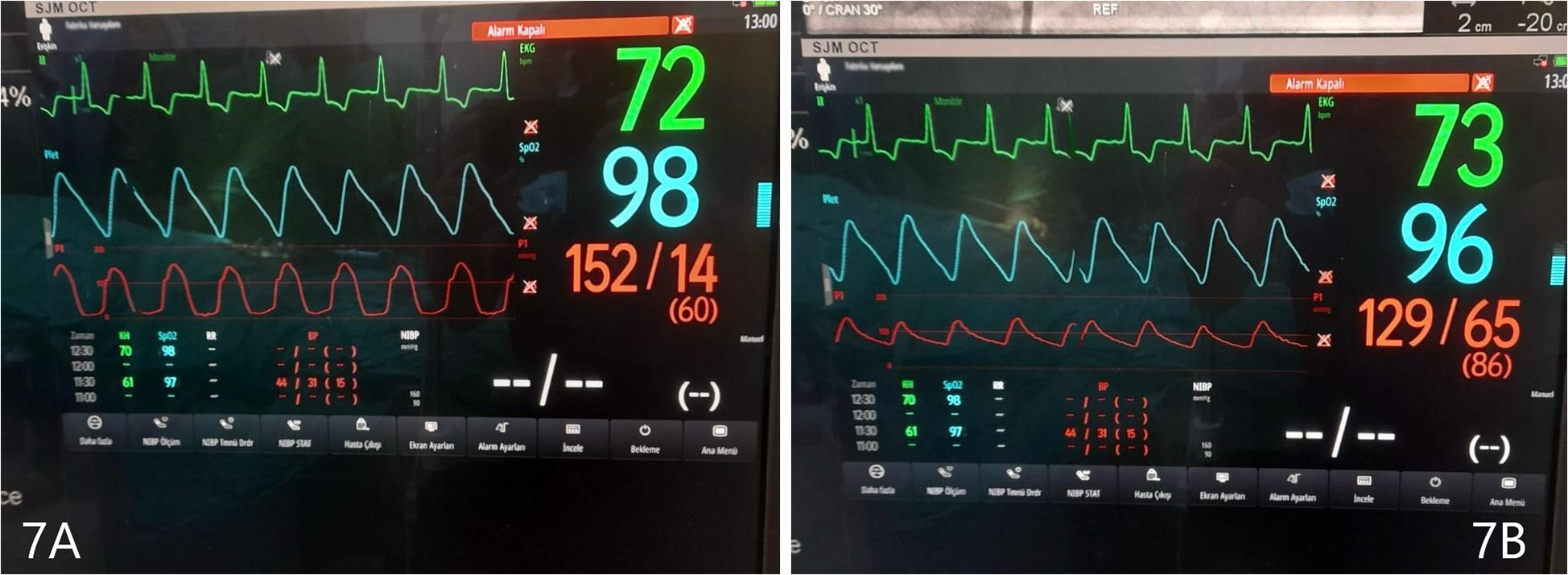 Side-by-side display screens show vital signs monitoring in a medical setting. The screens include ECG waveforms, heart rates of 73 beats per minute, SpO2 levels of 98 and 96 percent, and blood pressure readings of 105/59 and 129/65. Various menu options and measurement times are visible at the bottom.
