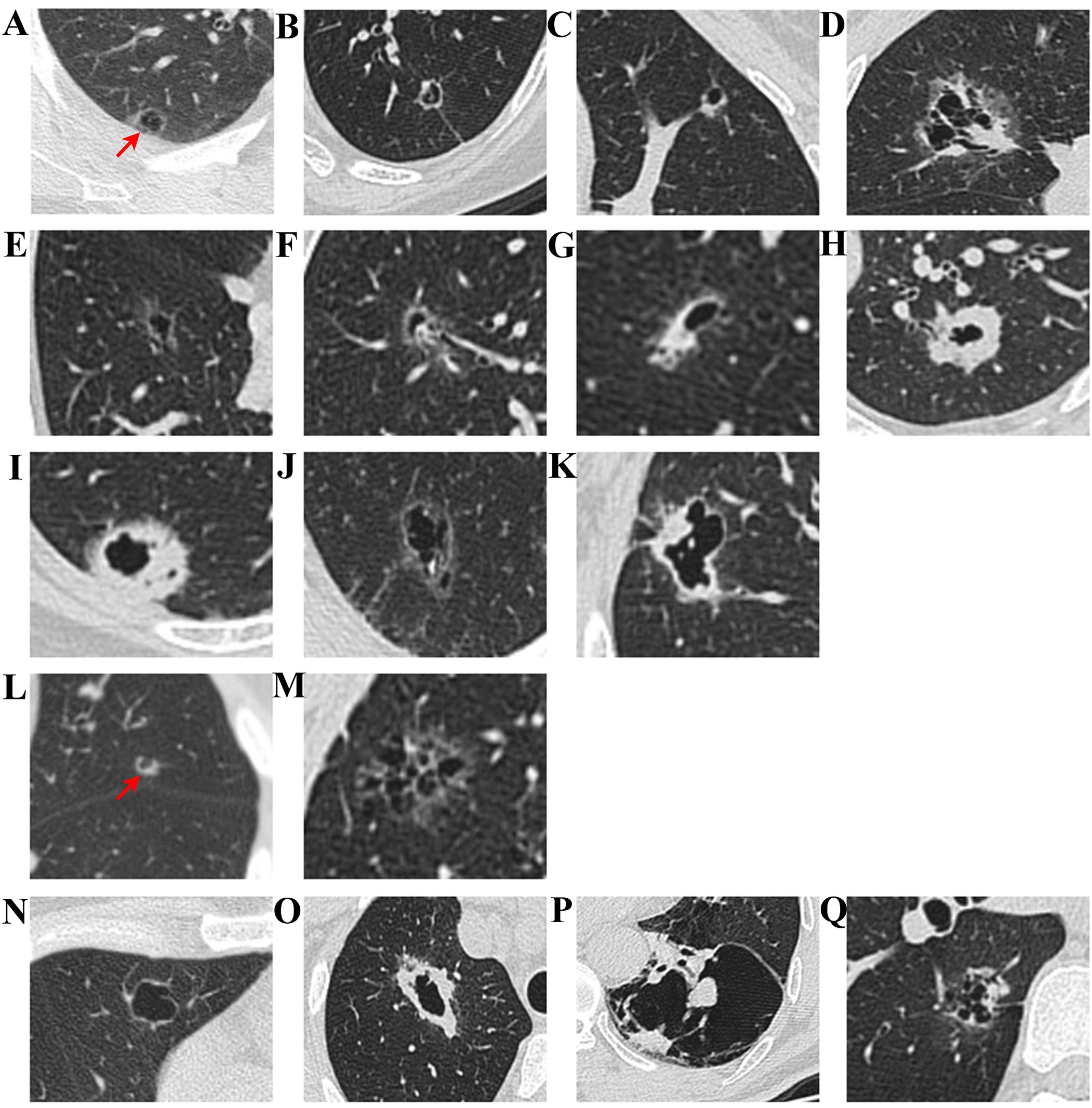 CT images of the lungs in panels labeled A to Q, displaying various lung structures and anomalies. Panel A shows a highlighted area with an arrow pointing to a small nodule. Panel L similarly has an arrow indicating a feature of interest. The other panels depict different lung cross-sections for comparative analysis.
