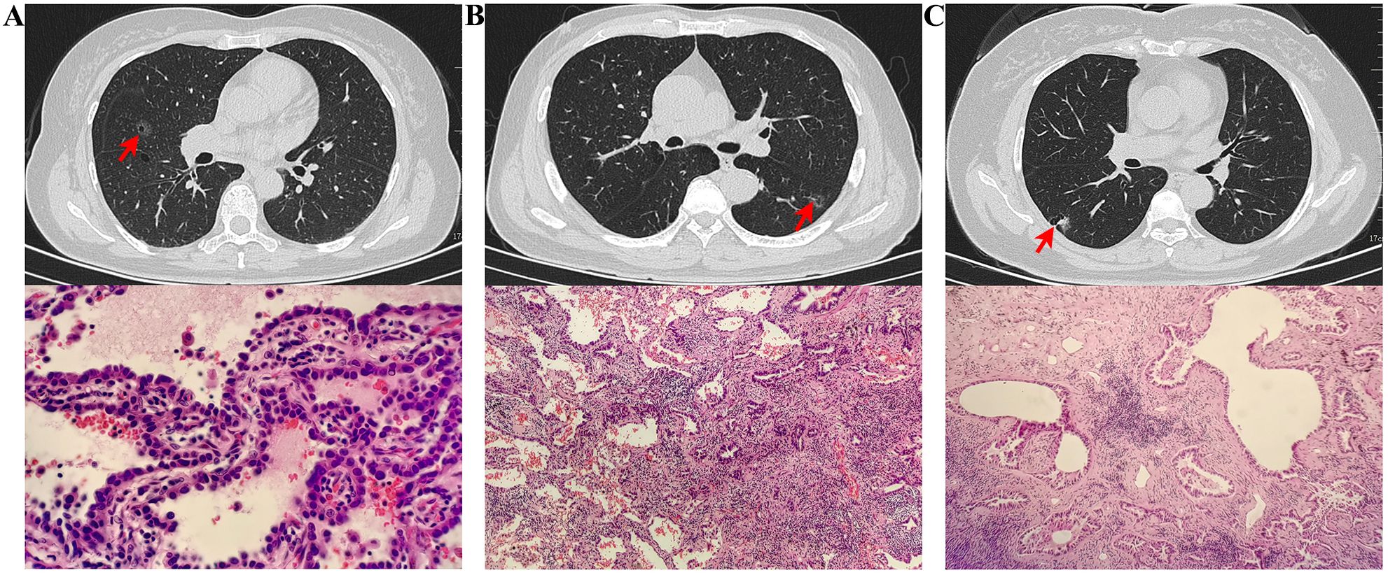 Three panels labeled A, B, and C show CT scans and corresponding histological images of lung tissue. The CT scans (top row) depict different lung sections with red arrows indicating specific areas of interest. The histological images (bottom row) display tissue samples with varying cellular structures and staining patterns. Each set of images highlights different features and pathologies within the lung tissue.