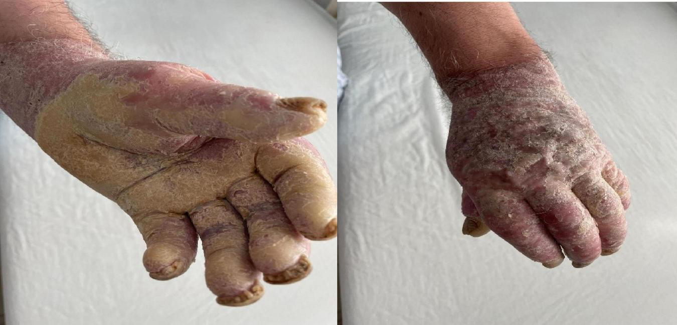 A hand is shown from different angles, displaying significant dryness and flakiness with peeling skin. The skin appears rough and chapped, with a whitish layer covering the surface.