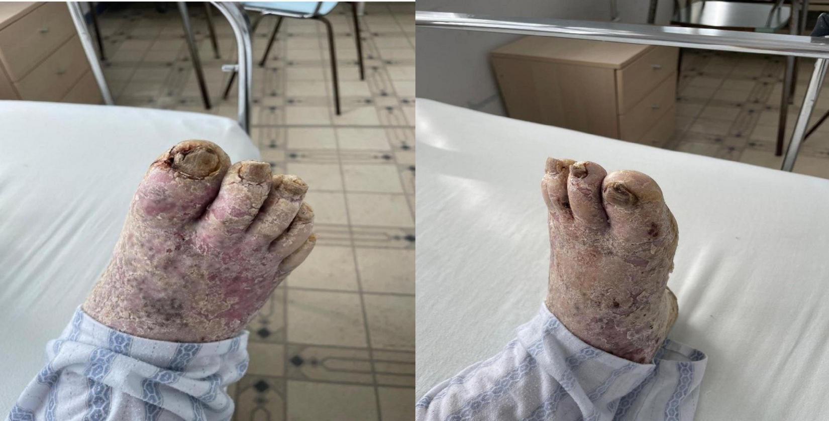 A foot with severe skin damage, showing thickened, discolored, and swollen areas, particularly around the toes. The toes have notable deformities and a crusty appearance. The background includes a hospital setting with a tiled floor, bed, and white linens.