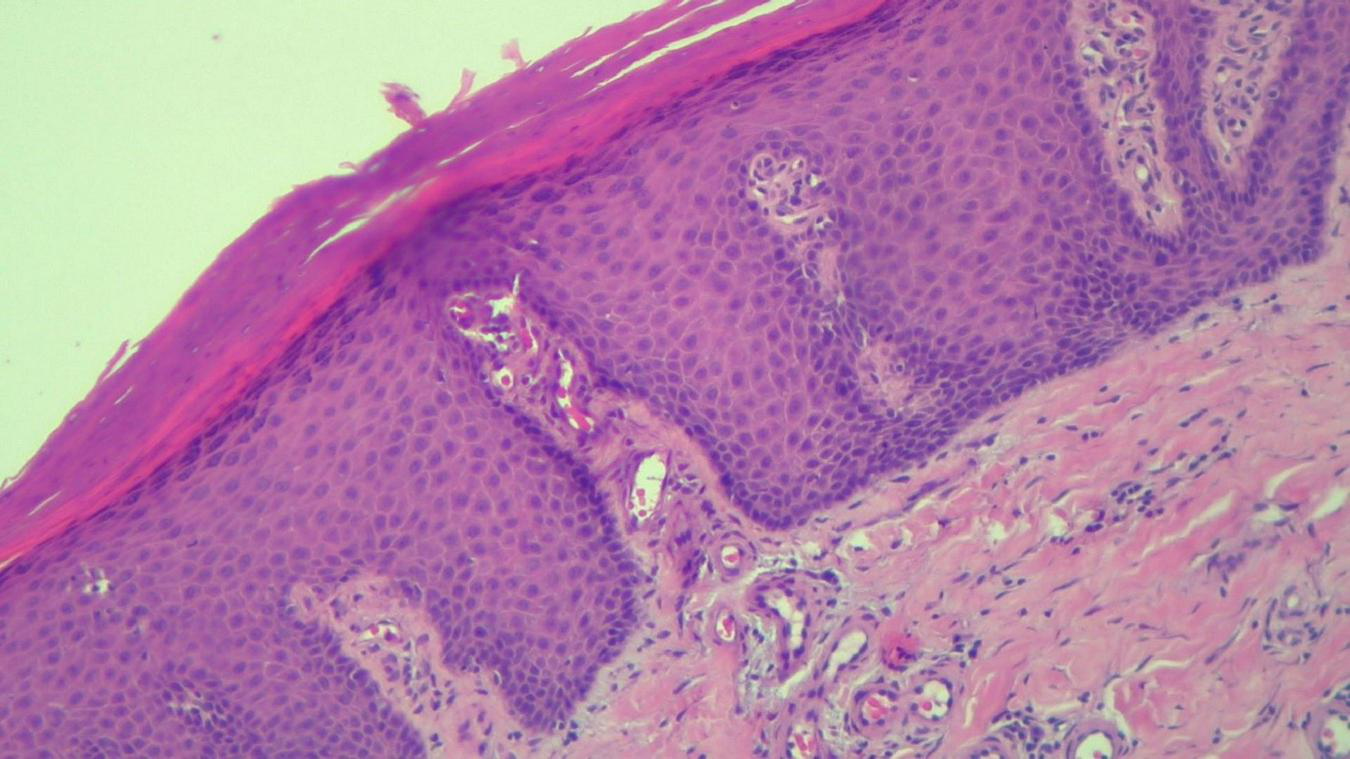Microscopic image of a cross-section of human skin, showing layers with varying cell densities. The outermost epidermis appears darker due to closely packed cells, while the underlying dermis has a lighter, fibrous texture. The image is stained with hematoxylin and eosin, giving pink and purple hues.