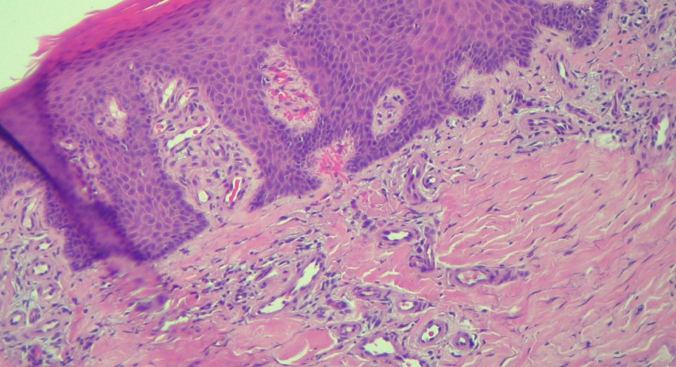 Histological image showing layers of cells stained in shades of pink and purple. The upper layer consists of tightly packed cells, while the lower layer features irregularly shaped cells with a fibrous texture.