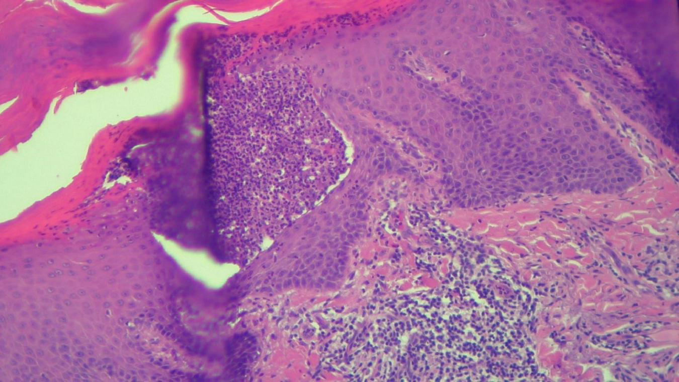 Microscopic image showing tissue stained in various shades of pink and purple. The cellular structures vary in density, with some areas appearing densely packed and others more sparse. The pink regions indicate connective tissue, while the purple areas represent clusters of cells.