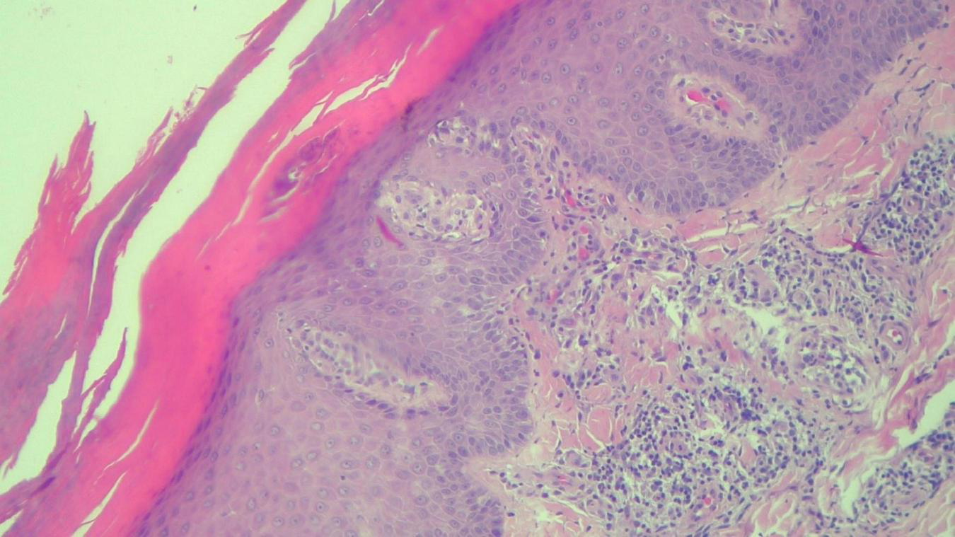 Microscopic image of human skin tissue stained in pink and purple hues. Layers of cells are visible, with distinct separation between the epidermis and dermis. The texture and density of cells vary across the sections, highlighting different tissue structures.