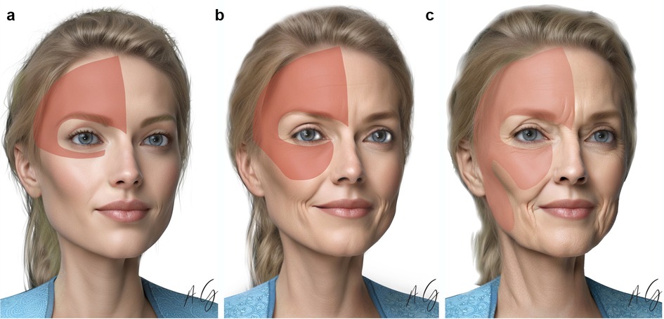 Three portraits compare facial aging, each highlighting a specific area around the eye and forehead. The left image shows a youthful face, the middle illustrates moderate aging, and the right depicts advanced aging, emphasizing wrinkles and sagging skin.